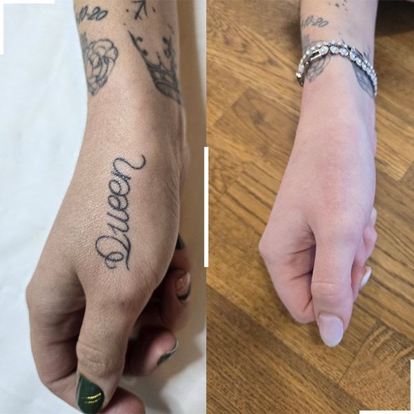 Tatouage avant et après détatouage laser, cas 1