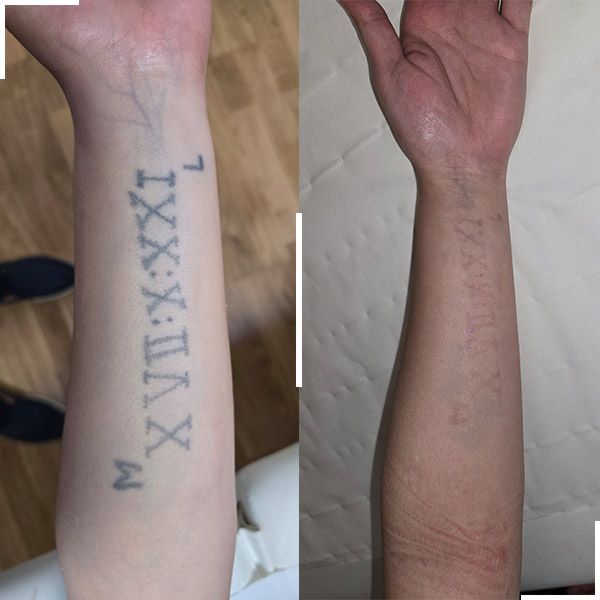 Tatouage avant et après détatouage laser, cas 3