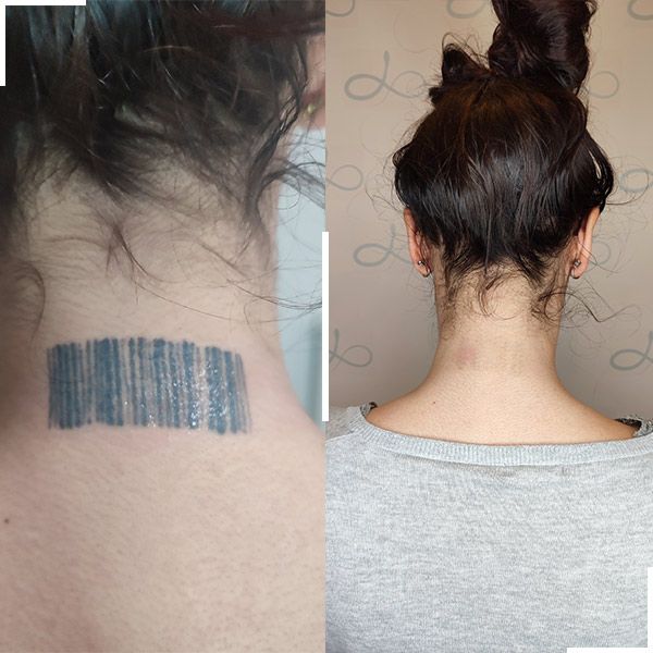 Tatouage avant et après détatouage laser, cas 4