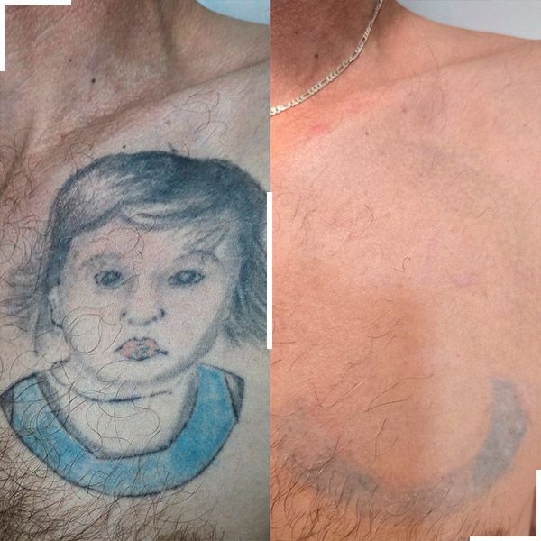 Tatouage avant et après détatouage laser, cas 5
